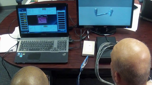 Amputé, il a désormais des bras bioniques !