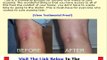 Eczema Free Forever Unbiased Review Bonus + Discount