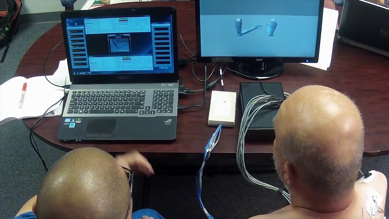 Amputé des 2 bras, il contrôle 2 bras mécaniques avec son cerveau