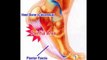 Exercises For Plantar Fasciitis Recovery - 5 Minutes Method