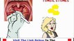 All the truth about Banish Tonsil Stones Bonus + Discount