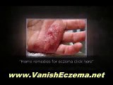 In the event Cure Child Eczema you are looking for