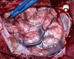 Nas Mãos da Cirurgia - Ep1 - No Interior do Cerebro - Odisseia