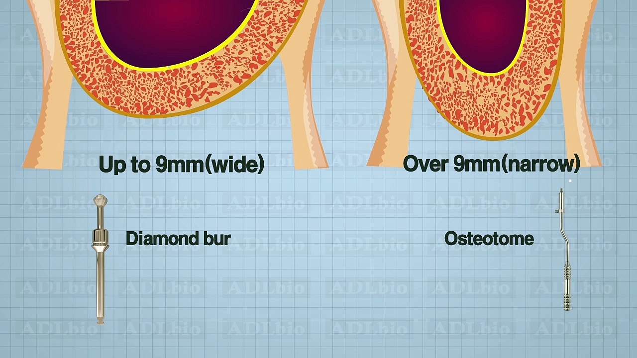 Safe Sinus Diamond