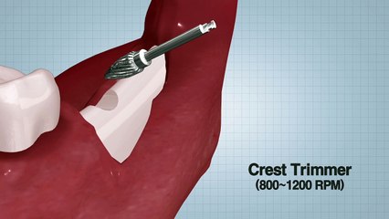 Single Bone Expander