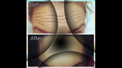 Botox Leeds - www.claesthetics.com