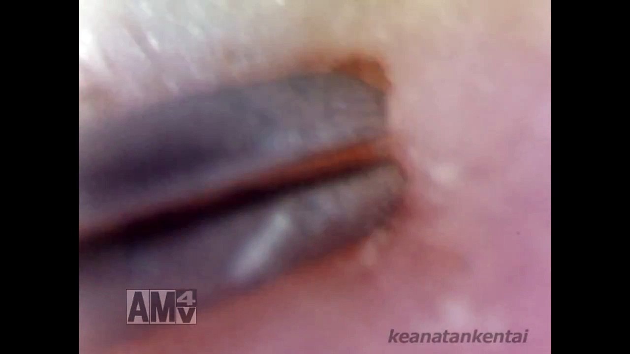 通常の？？倍の角栓を発見！（large keratin plug）［Whitehead/Blackhead］