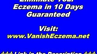 Healing Eczema The Natural Way - How to Beat Eczema Naturally And Drug-Free!