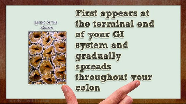 Can Digestive Enzyme Treat My Ulcerative Colitis?