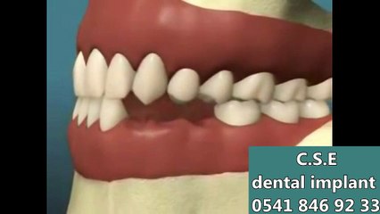 İMPLANT DİŞ YAPIMI