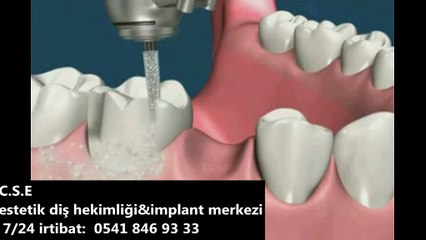 METAL DESTEKLİ PORSELEN