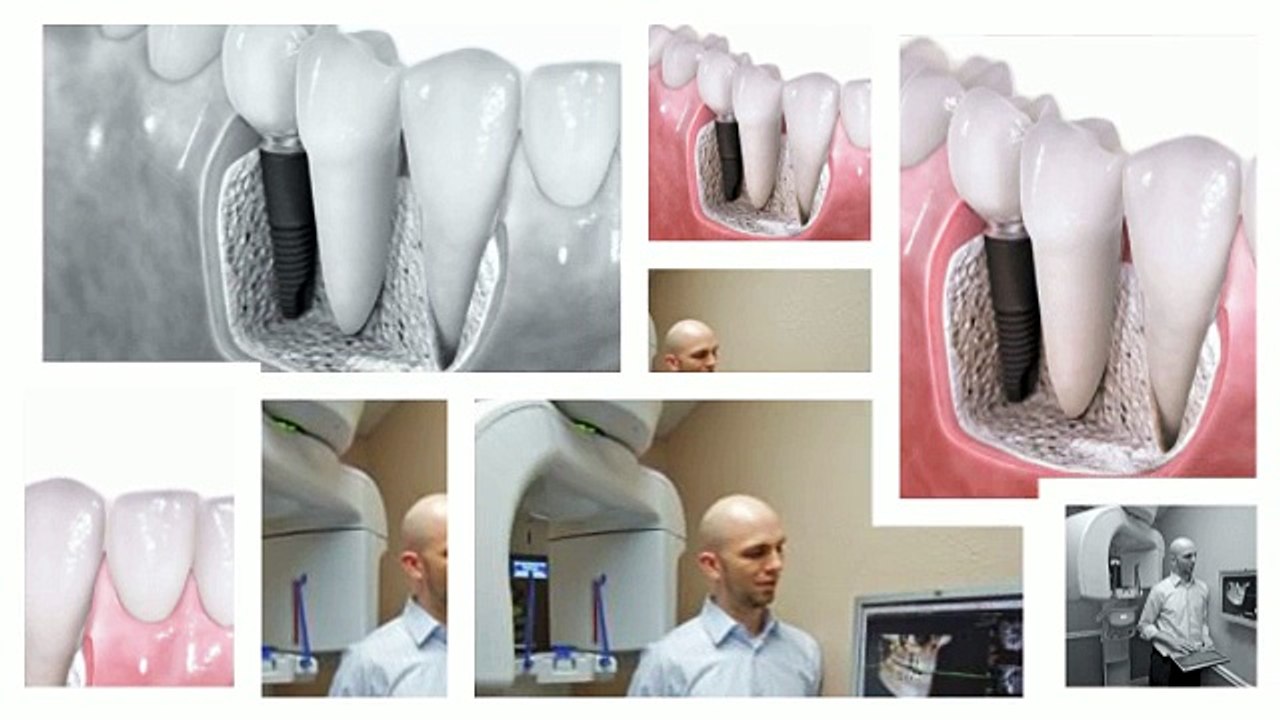 Dental Implants in Anchorage, AK