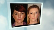 Rhinoplasty Procedure by Dr Tavakoli to Give your Nose the Desired Shape