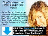 Charles Davidson Moles Warts Skin Tags Removal Review   Moles Warts & Skin Tags Removal Ebook Review