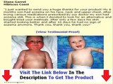 Eczema Free Forever Don't Buy Unitl You Watch This Bonus   Discount