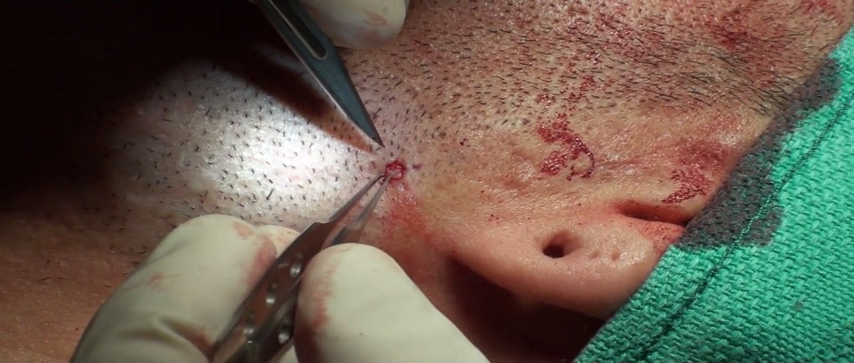Acne Scar Revision Part 02 Subcision Technique by Dr. Young Bellevue