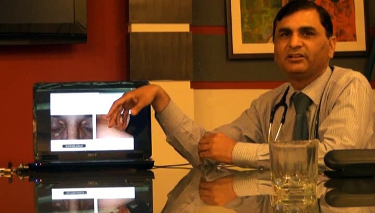 Diabetes Session On Metabolic Syndrome BY Dr Javed Part 8