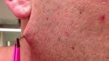The Longest Grossest Ingrown Hair In History Dailymotion Video