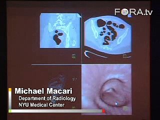 Virtual Colonoscopies and How They Work