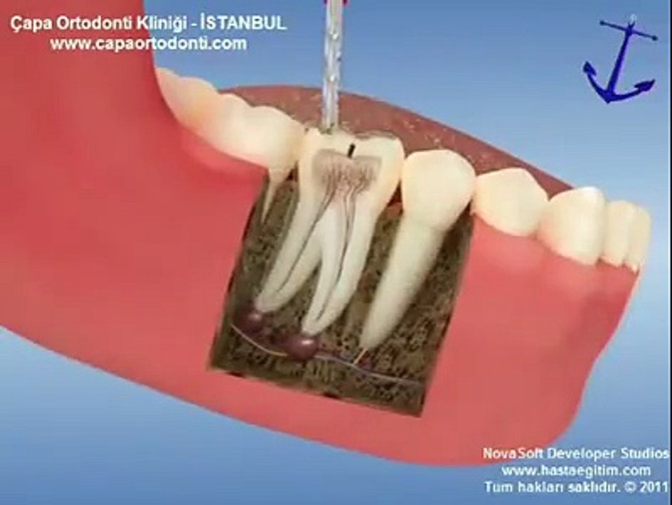 Making orthodontic appliances
