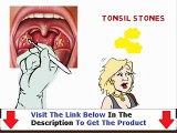 Banish Tonsil Stones THE HONEST TRUTH Bonus + Discount