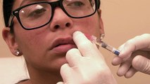 Restylane Filler Injections in Connecticut at Jandali Plastic Surgery