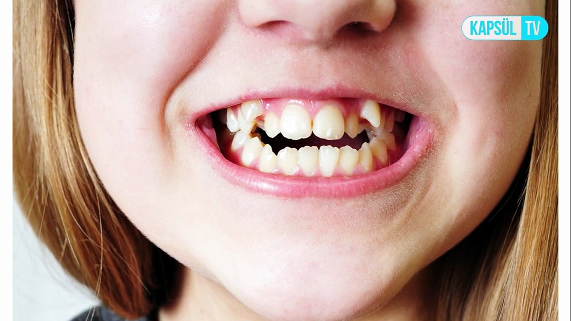 Sut Disleri Ne Zaman Dokulur Cektirmek Zararli Midir Dailymotion Video