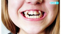 Süt Dişleri Ne Zaman Dökülür? Çektirmek Zararlı Mıdır?