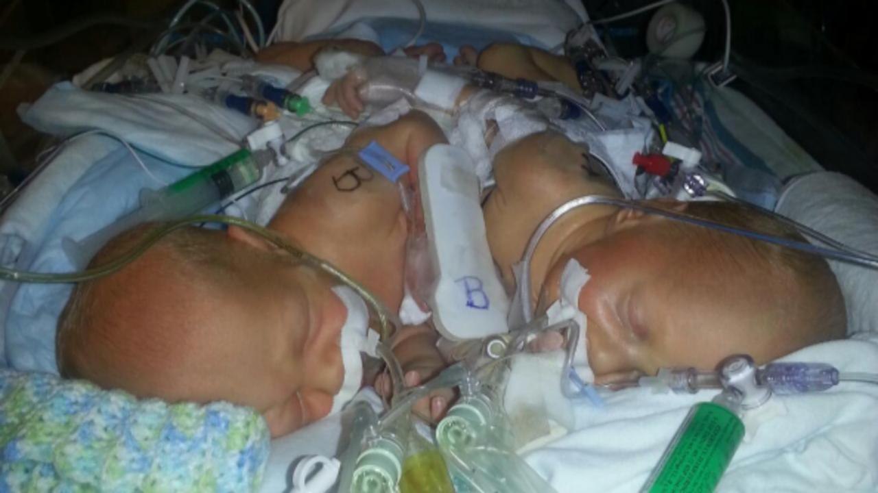 Conjoined Twins In Florida Survive Their First Surgery