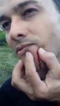 Une Bille d'airsoft coincée dans le visage après un tir accidentèle