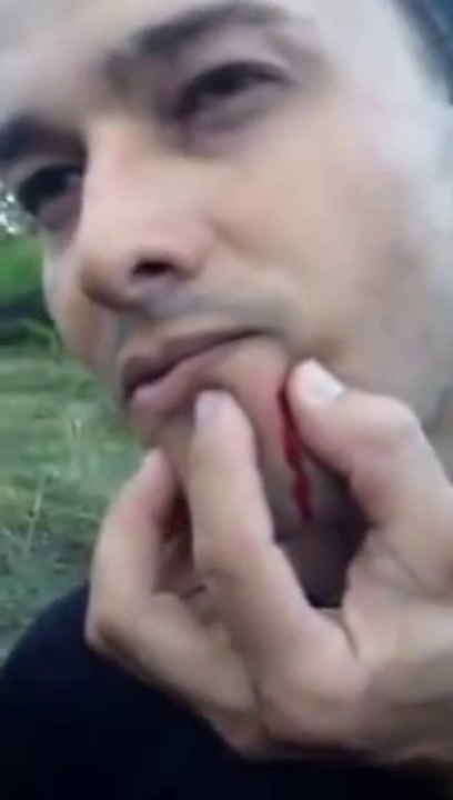 Une Bille d'airsoft coincée dans le visage après un tir accidentèle