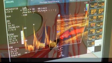 Arteries of Vegans vs. Runners