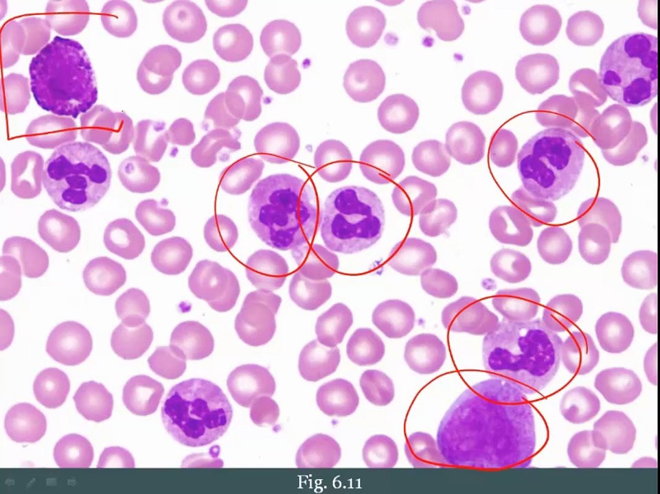 Myeloproliferative Disorders