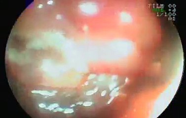 大腸カメラ（ダックス直腸ポリープ）【垂水オアシス動物病院】