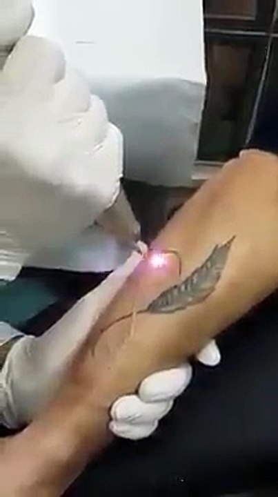 This is How a Tattoo can be removed now