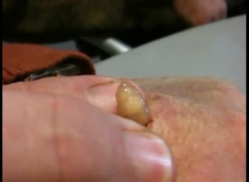 Il laisse grandir une larve de mouche dans sa main