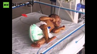 Bébé nasce na Índia com pele de “plástico
