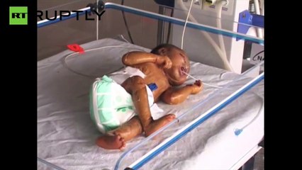 Bébé nasce na Índia com pele de “plástico"!
