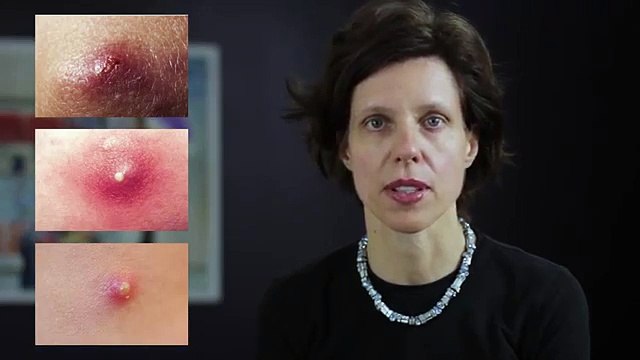 Learn How To Treat Severe Acne - by Dr. Franziska Ringpfeil, Board Certified Dermatologist