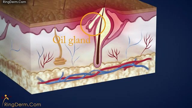 Photodynamic Therapy Treatment For Acne in Philadelphia