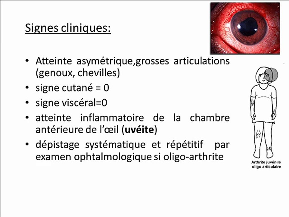 Arthrite juvénile