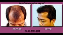 Best Hair Transplant in Pakistan, hair loss treatment