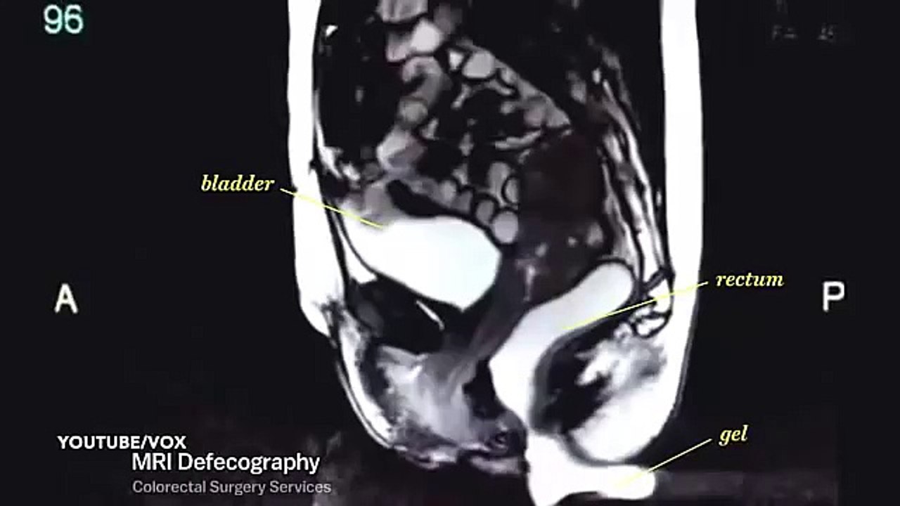 Amazing MRI scan video captures couple having sex