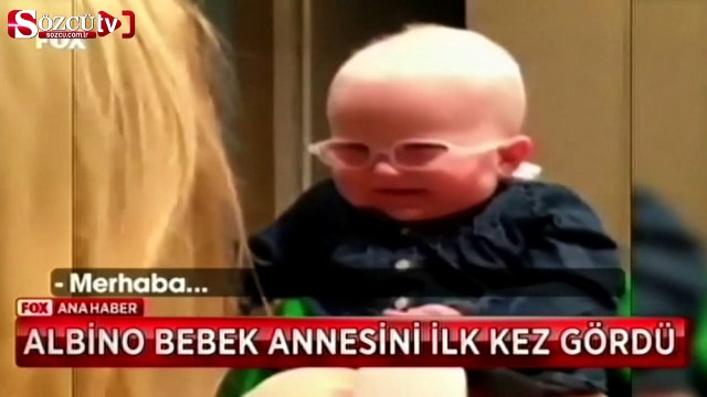 Albino bebek annesini ilk kez gördü
