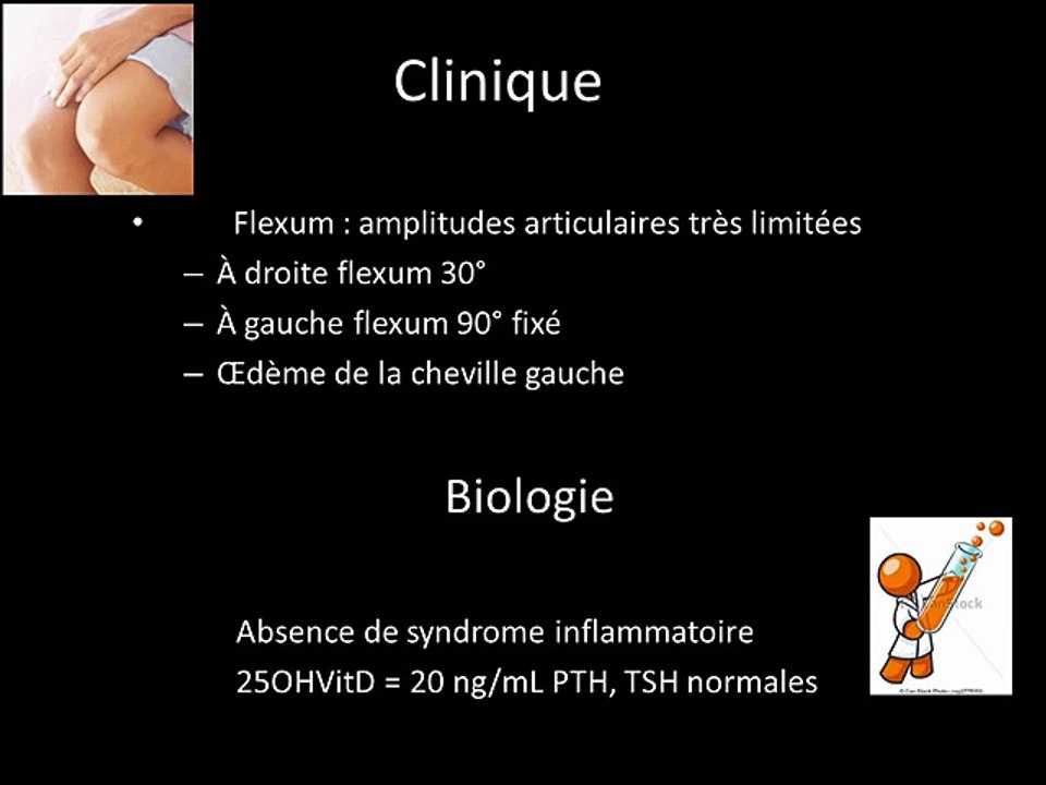 Algodystrophie