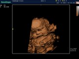 Sonoscape S8 Color Doppler Ultrasound / 4D Real Time Baby