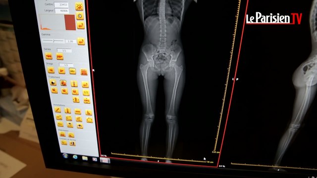 EOS, le radioscope qui vous expose à six fois moins de radioactivité