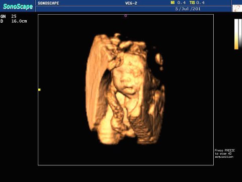 Color Doppler Ultrasound Machine Sonoscape S8 with 3D and 4D Function