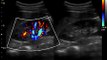 Kidney Video with Chison Q9 Color Doppler Ultrasound