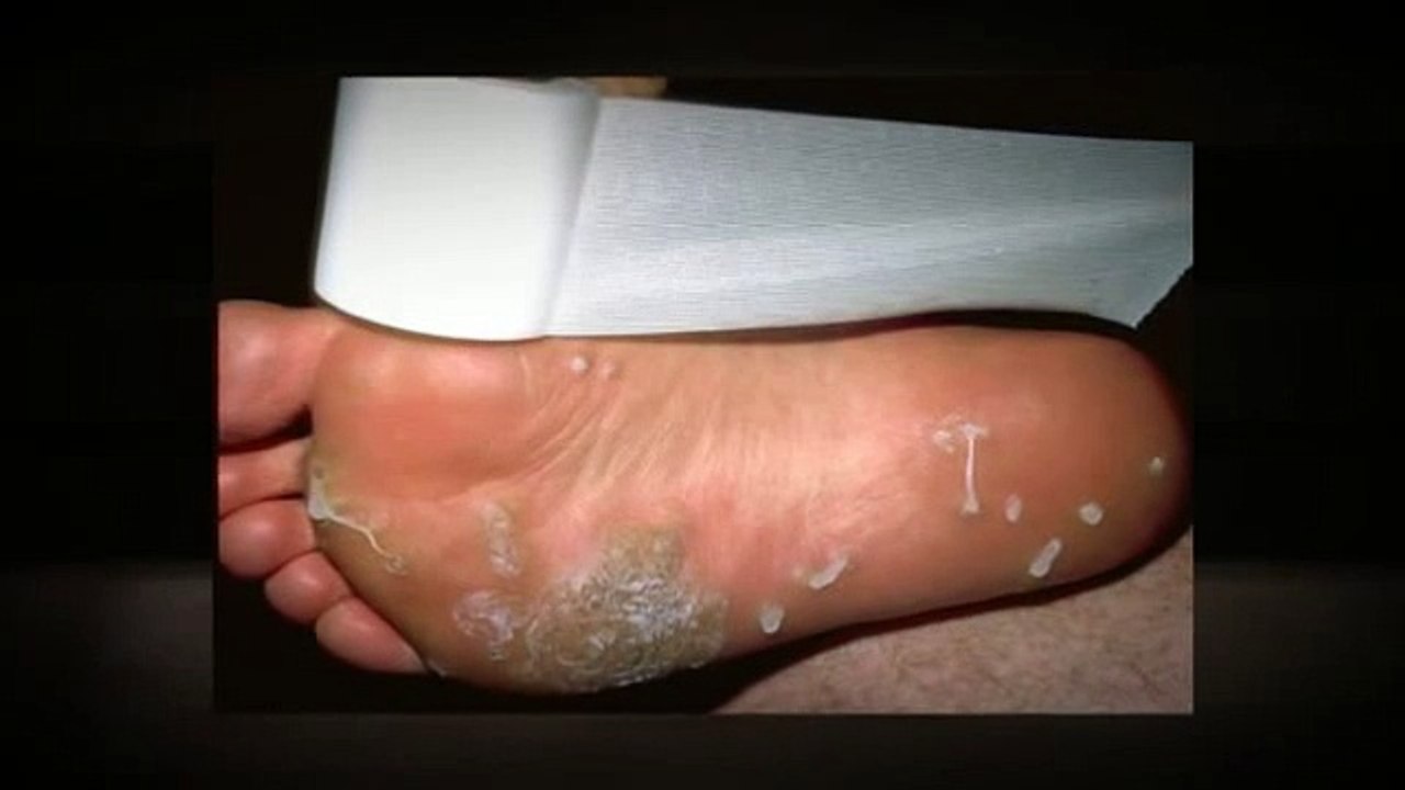 Top 5 Facts About Warts